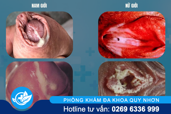 chu-y-lau-man-tinh-tranh-bien-chung-nguy-hiem-2