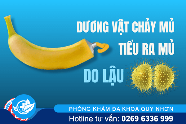Dương vật chảy mủ hoặc tiểu ra mủ cẩn thận với lậu
