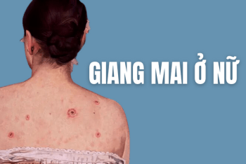 Giang mai ở nữ và sự thật cần biết