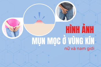 Hình ảnh mụn mọc ở vùng kín nữ và nam giới