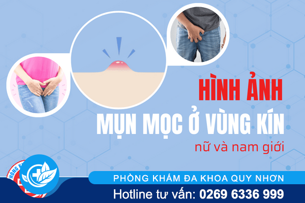Hình ảnh mụn mọc ở vùng kín nữ và nam giới