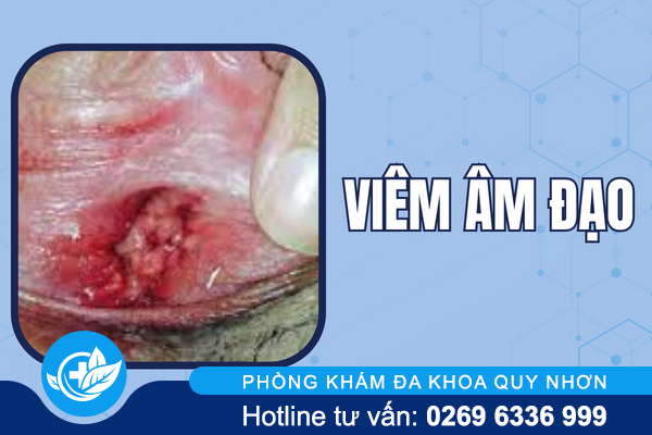 hinh-anh-mun-moc-o-vung-kin-nu-va-nam-gioi-2