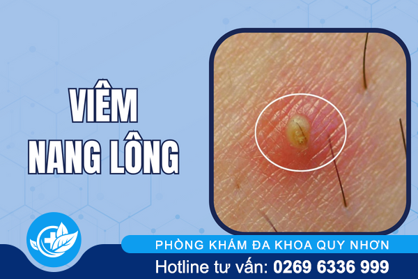 hinh-anh-mun-moc-o-vung-kin-nu-va-nam-gioi-3