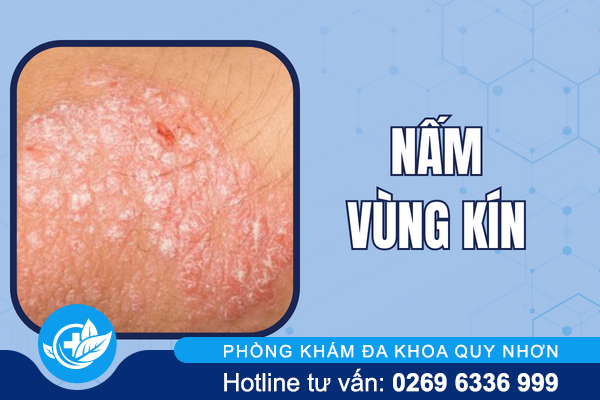 hinh-anh-mun-moc-o-vung-kin-nu-va-nam-gioi-4