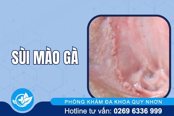 hinh-anh-mun-moc-o-vung-kin-nu-va-nam-gioi-5