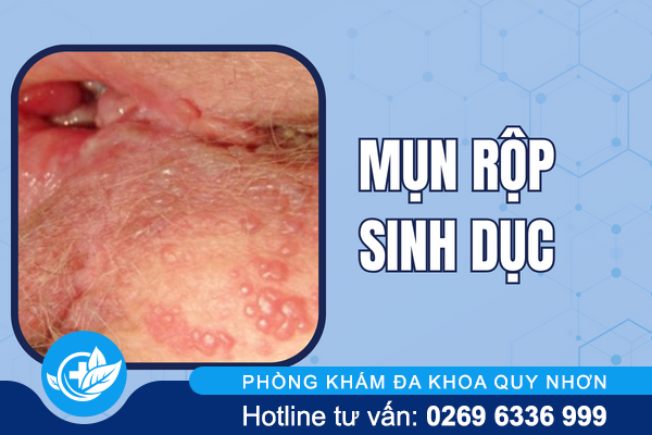 hinh-anh-mun-moc-o-vung-kin-nu-va-nam-gioi-6