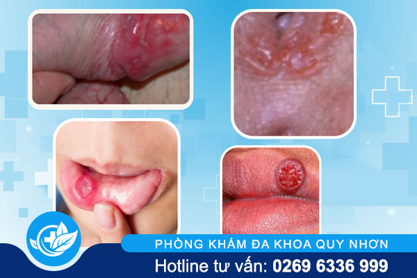 nhan-biet-hinh-anh-giang-mai-giai-doan-dau-05