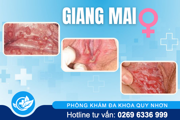 nhan-biet-hinh-anh-giang-mai-giai-doan-dau-6