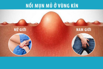 Nổi mụn mủ vùng kín cảnh báo bệnh xã hội nguy hiểm