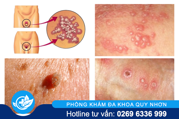 noi-mun-mu-vung-kin-canh-bao-benh-xa-hoi-nguy-hiem-1