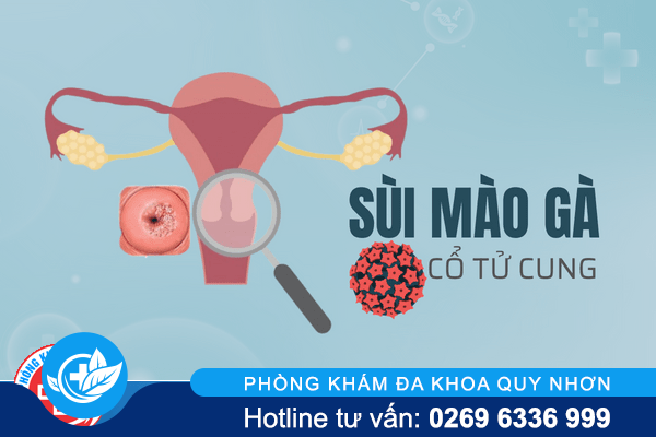 Sùi mào gà cổ tử cung – Khó nhận biết và nguy hiểm khôn lường