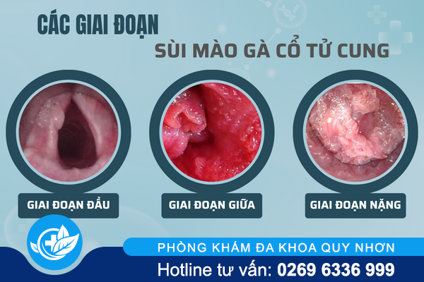 sui-mao-ga-co-tu-cung-kho-nhan-biet-va-nguy-hiem-khon-luong-1