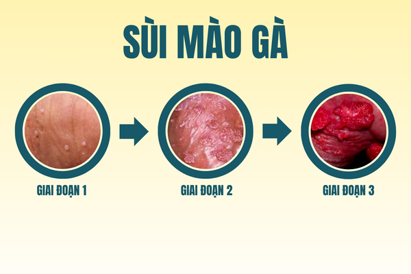 thong-tin-benh-xa-hoi-o-nam-va-nu-can-luu-y-1