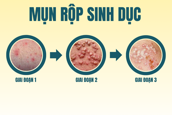 thong-tin-benh-xa-hoi-o-nam-va-nu-can-luu-y-2