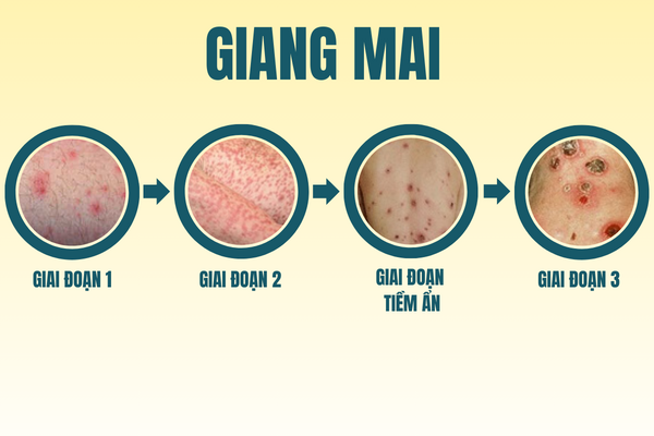 thong-tin-benh-xa-hoi-o-nam-va-nu-can-luu-y-4