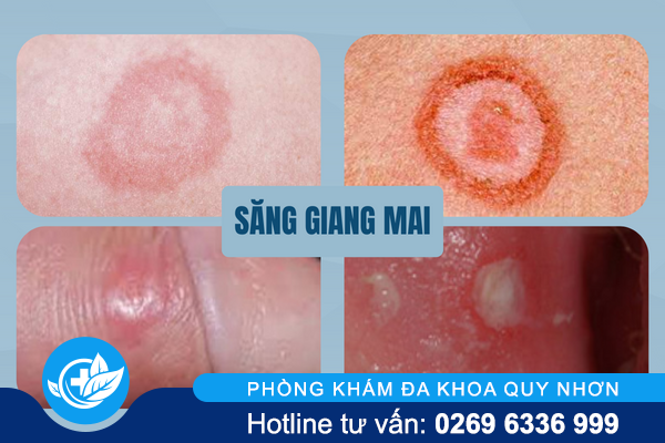 xac-dinh-thoi-gian-u-benh-giang-mai-2