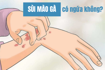 Sùi mào gà có ngứa không?