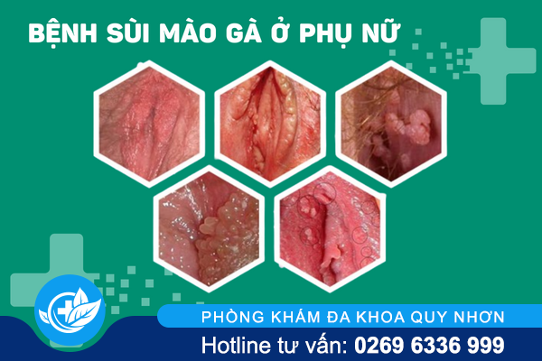 benh-sui-mao-ga-o-phu-nu-va-toan-bo-thong-tin-can-biet-2