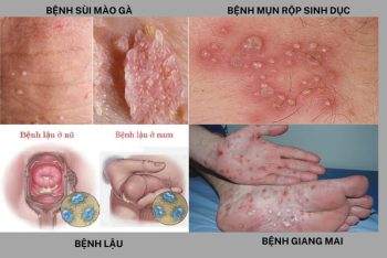 Bệnh hoa liễu căn bệnh nguy hiểm cần phát hiện sớm