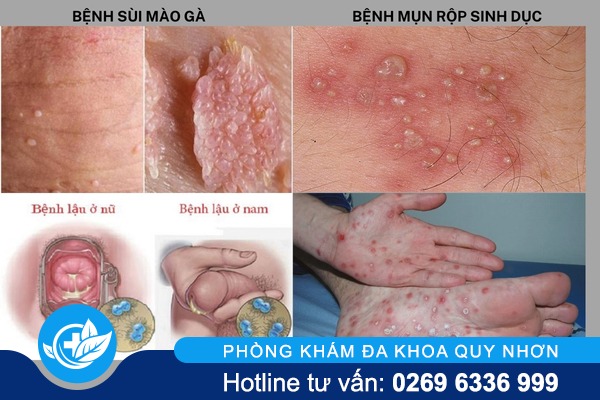 Bệnh hoa liễu căn bệnh nguy hiểm cần phát hiện sớm