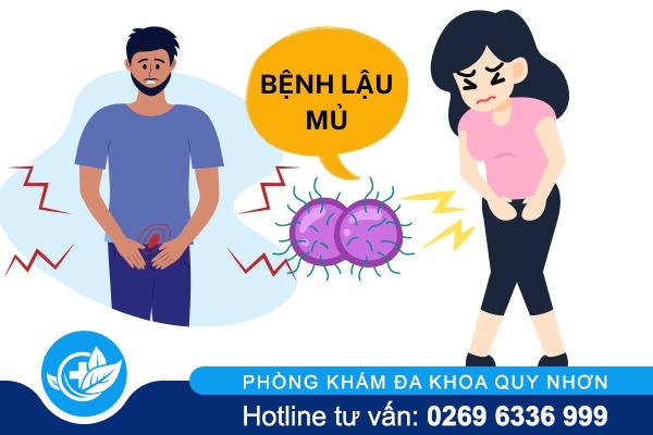 Dấu hiệu bệnh lậu mủ tác hại và cách điều trị