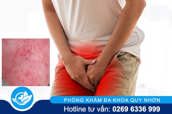 Mụn Bao Quy Đầu: Dấu Hiệu Cảnh Báo Bệnh Nam Khoa?