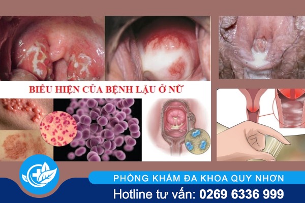dau-hieu-benh-lau-nu