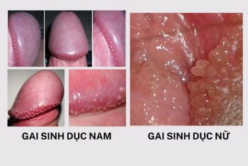Gai sinh dục là gì và có nguy hiểm không?