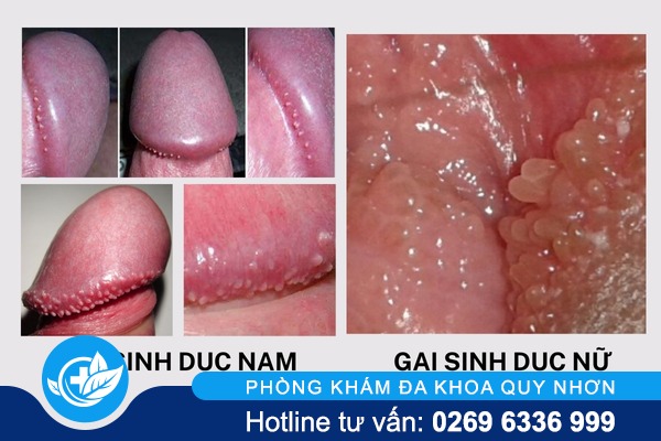 Gai sinh dục là gì và có nguy hiểm không?