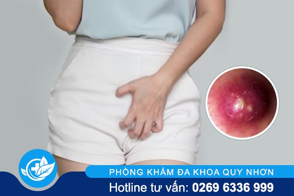 Tình trạng nổi mụn ở môi lớn, môi bé là bị bệnh gì?