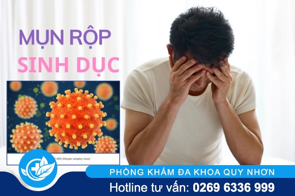 Dấu hiệu giúp sớm nhận biết mụn rộp sinh dục