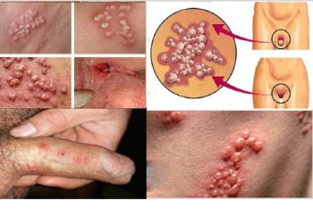 Những thông tin cần biết về bệnh mụn rộp sinh dục