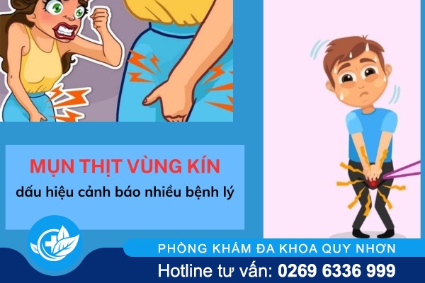 Mụn thịt vùng kín cảnh báo bệnh gì?