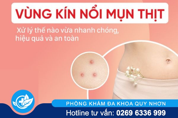 Mụn thịt vùng kín cảnh báo bệnh gì?