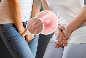 Nguyên nhân nào gây ra mụn vùng kín và cách điều trị