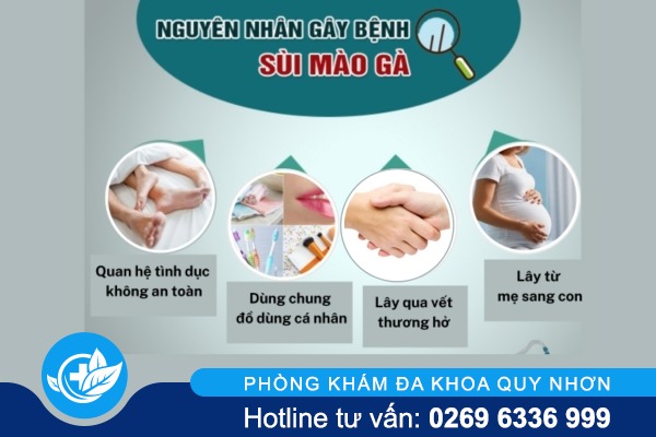 Nguyên nhân sùi mào gà ai cũng cần biết