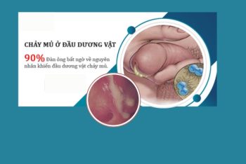 Quy đầu chảy mủ dấu hiệu nguy hiểm không nên xem thường
