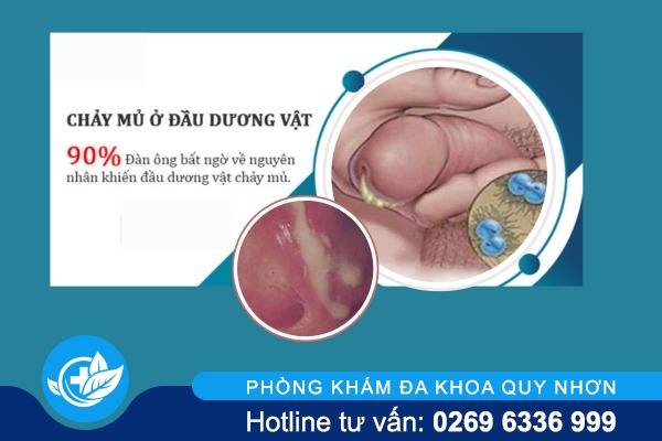 Quy đầu chảy mủ dấu hiệu nguy hiểm không nên xem thường