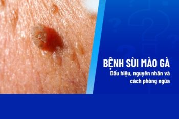 Những thông tin  cần biết về sùi mào gà