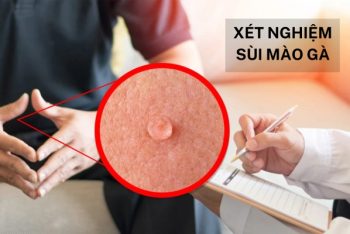 Xét nghiệm sùi mào gà bằng cách nào chi phí bao nhiêu?