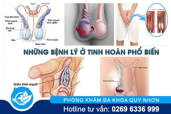 Bệnh tinh hoàn là gì? Những vấn đề nam giới cần biết