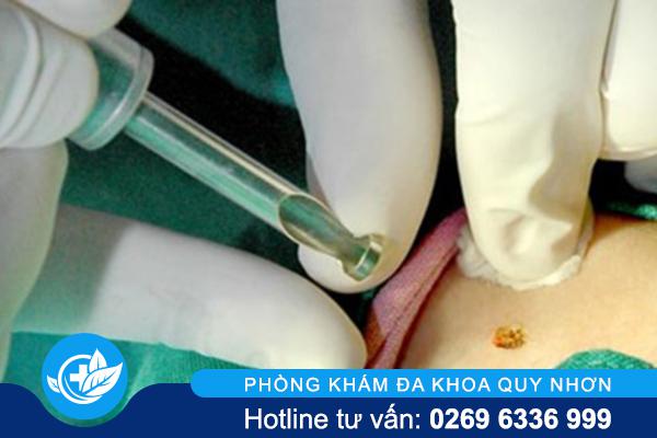 Đốt mụn sinh dục: Có thật sự khỏi hay chỉ là giải pháp tạm thời?