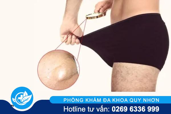 Hiểu Đúng Về Tình Trạng Dương Vật Nổi Hạch Để Điều Trị Kịp Thời