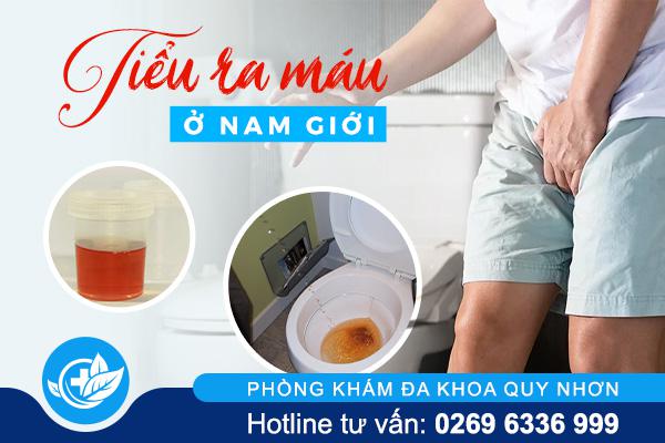 Thắc mắc vì sao bị đi tiểu ra máu ở nam