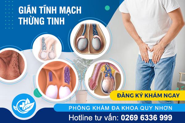 Giãn tĩnh mạch thừng tinh: Bệnh nam khoa ảnh hưởng đến khả năng sinh sản
