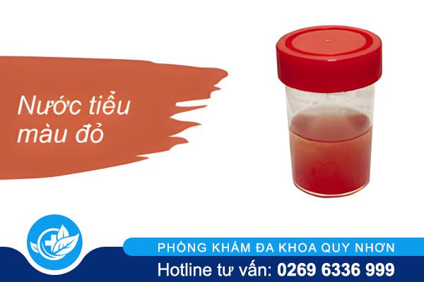 Nước tiểu có màu đỏ  – Dấu hiệu “đỏ” cảnh báo bệnh nam khoa nguy hiểm