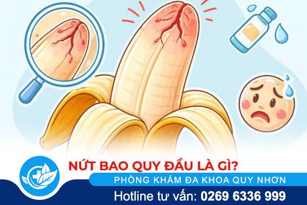 Nứt Bao Quy Đầu: Dấu Hiệu Cảnh Báo Viêm Nhiễm Không Nên Chủ Quan