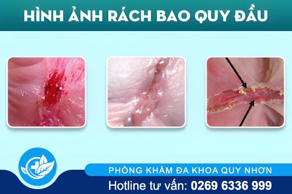 Rách Bao Quy Đầu – Cảnh Báo Tổn Thương Nguy Hiểm Nam Giới Không Nên Chủ Quan
