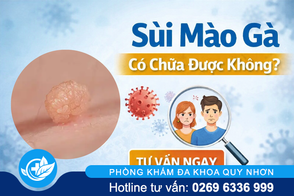 Sùi mào gà có chữa được không?