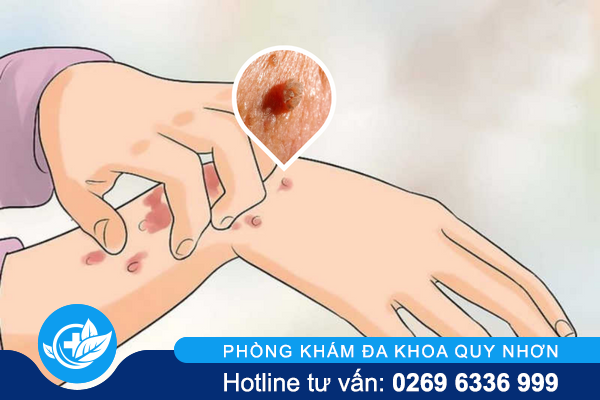 Sùi mào gà có ngứa không?